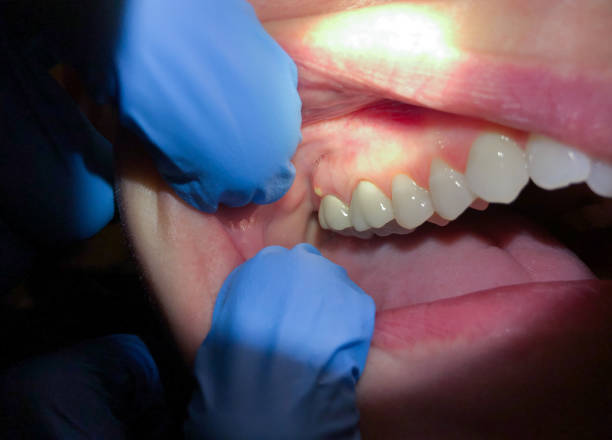 Best Emergency Treatment for Dental Infections or Abscesses in Mount Cob, PA