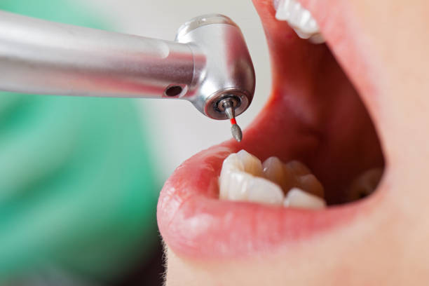 Best Emergency Dental Care for Broken or Chipped Teeth in Mount Cob, PA